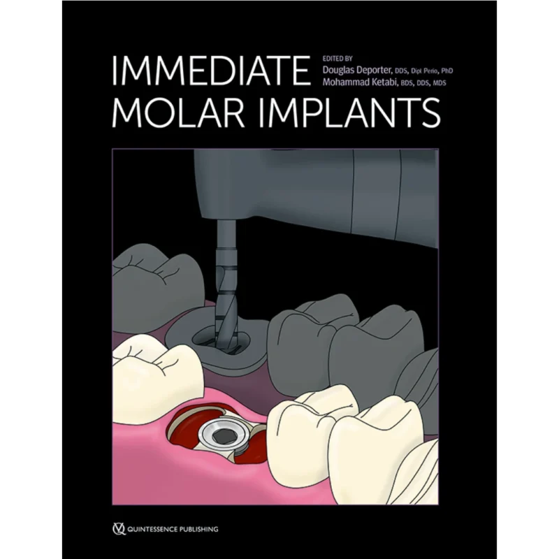 Immediate Molar Implants