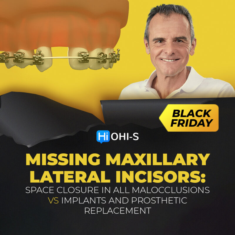 Missing Maxillary Lateral Incisors: Space Closure in all Malocclusions vs Implants and Prosthetic Replacement