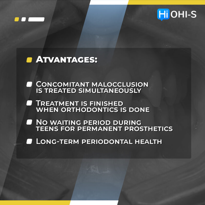 Missing Maxillary Lateral Incisors: Space Closure in all Malocclusions vs Implants and Prosthetic Replacement - Image 2