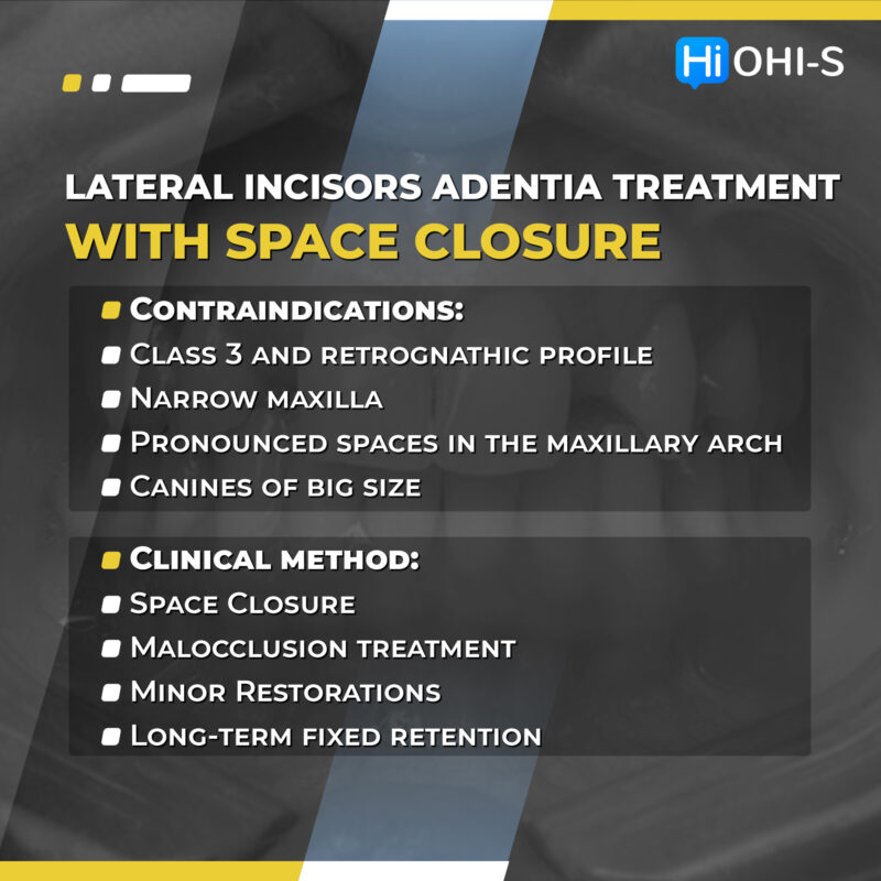 Missing Maxillary Lateral Incisors: Space Closure in all Malocclusions vs Implants and Prosthetic Replacement - Image 3