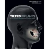 Tilted Implants: Implant-prosthetic Rehabilitation of the Atrophic Patient